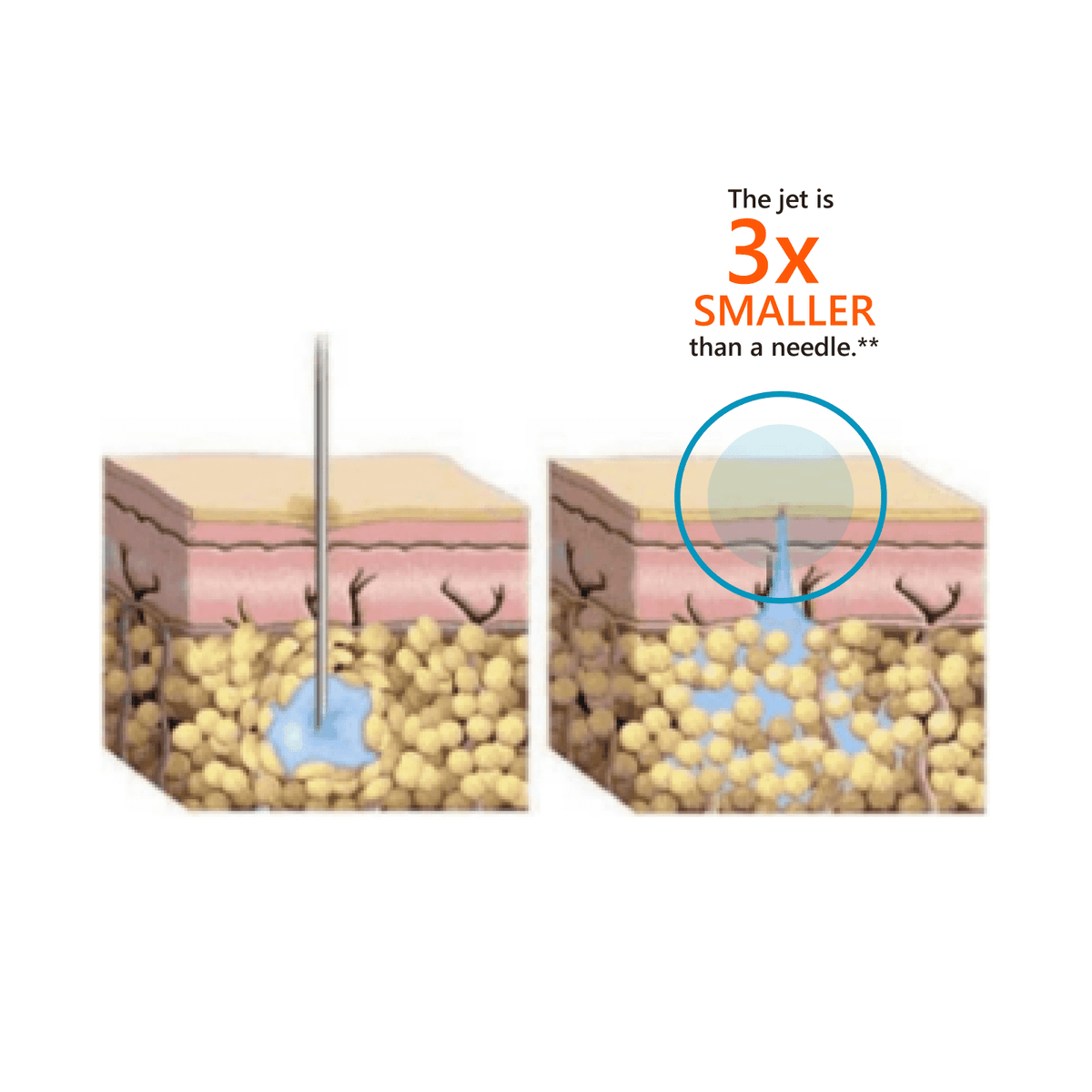 InsuJet™ Injector V5